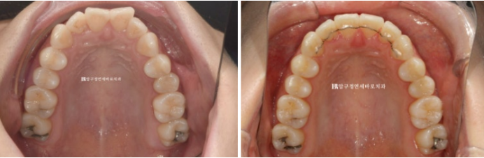 Can Rabbit Teeth Be Corrected? 5-Month Real Case of Butterfly Teeth Anterior Partial Orthodontic Treatment image 7