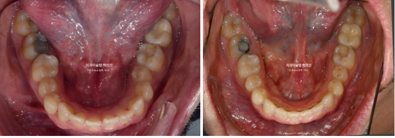 앞니 선천적 결손 인비절라인 임플란트 과개교합 치료 기간 관련 이미지 25