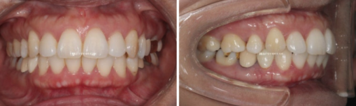 Orthodontic Retreatment in Your 40s | Improvement of Chin Retrusion and Lip Incompetence with Intrusion Orthodontics, Non-Extraction Orthodontic Treatment in Your 40s image 1