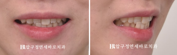 앞니부분교정 기간? MTA 미니튜브 교정 반대교합 교정 관련 이미지 4