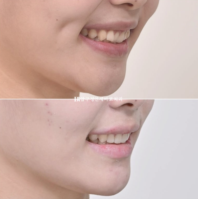 옥니 교정 인비절라인 라이트 옹니 덧니 치료기간 ? 관련 이미지 1