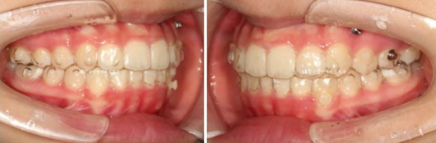 어린이 투명교정 인비절라인 틴 덧니 교정 후기 관련 이미지 8