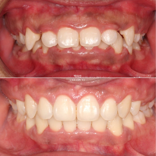 거미스마일 잇몸미소 발치 돌출입 과개교합 교정 후기 관련 이미지 13
