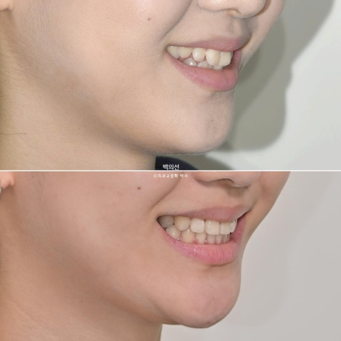 비발치 덧니교정 인비절라인 교정 사랑니 이용 교정 관련 이미지 1