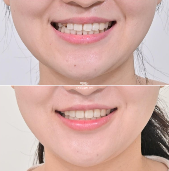 매복 결손 잔존유치 라미네이트 크라운 캔팅 인비절라인 라이트 치료 관련 이미지 1