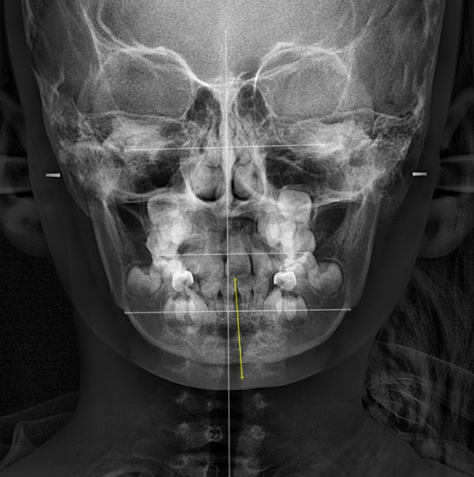 소아 비대칭 교정 인비절라인 퍼스트 재제작 1회 MA 치료 관련 이미지 4