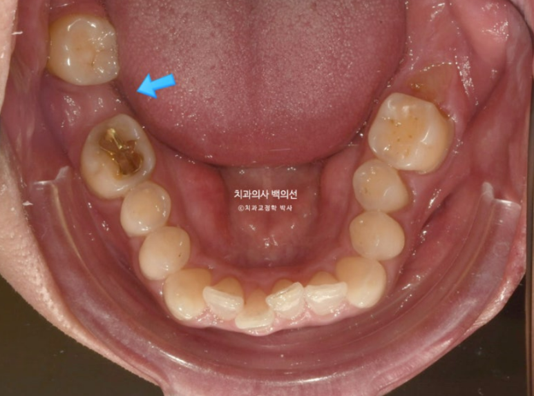 40대 인비절라인 라이트 과개교합 과잉치 덧니 교정 임플란트 보철 교정 후기 관련 이미지 6