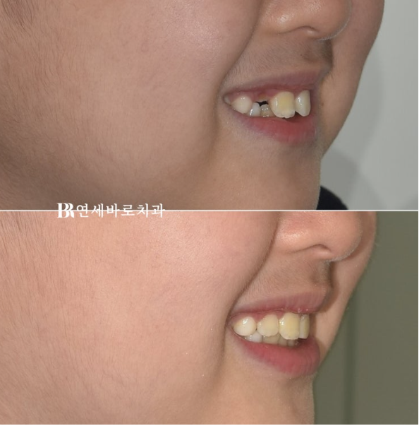 A Real Case of Preventing Crowded Teeth with Invisalign First for a Child in Gangnam image 9