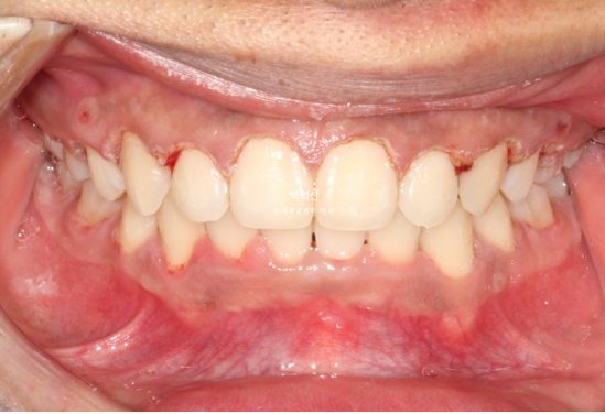 거미스마일 잇몸미소 발치 돌출입 과개교합 교정 후기 관련 이미지 8
