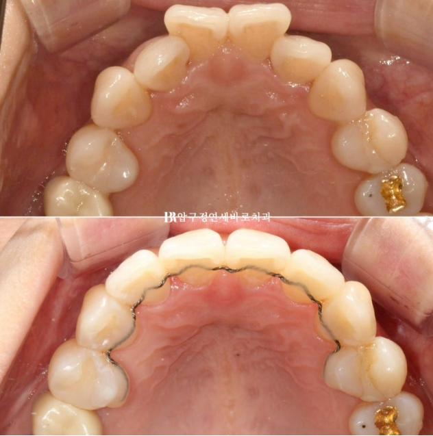 토끼이빨도 부분교정이 가능할까요? 30대 앞니 반대교합 6개월 치료 사례 관련 이미지 10