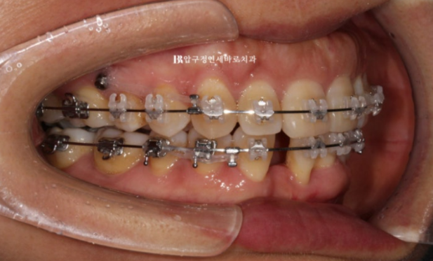 40대 치아교정 가능할까요? 치주염 있어도 치아교정 가능할까요? 임플란트 없이 교정하기 관련 이미지 5