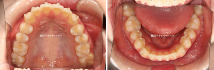Orthodontic Treatment for International Students: Is Short-Term Treatment Possible in Korea? | A Real 5-Month Front Teeth Partial Orthodontic Case image 5
