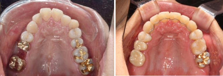 거미스마일 교정 돌출입 발치교정 입술부전 호두턱 치료기간 2년반 관련 이미지 18