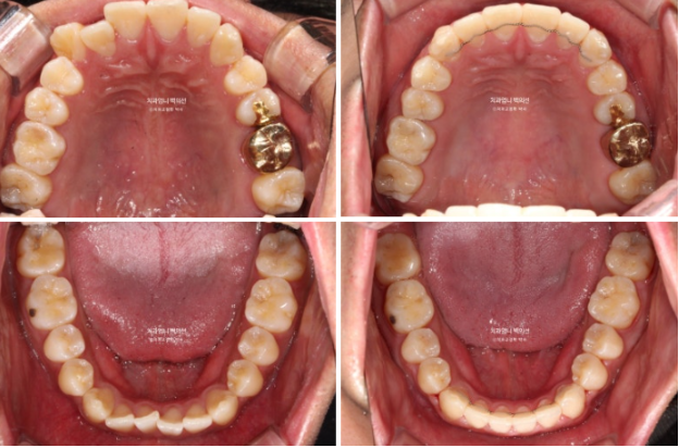 반대교합 비발치 교정 클리피씨 후기 관련 이미지 8