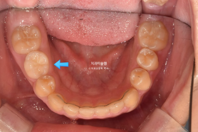 선천적 결손 잔존유치 과개교합 돌출입 인비절라인 퍼스트 어린이 투명교정 치료기간 관련 이미지 14