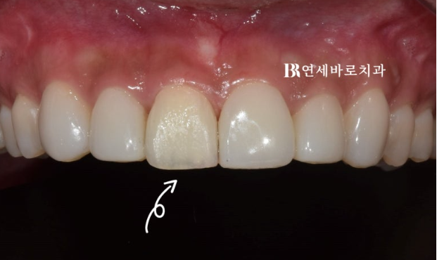 무삭제 라미네이트 젤라미 정말 최소삭제도 안할까? 관련 이미지 4