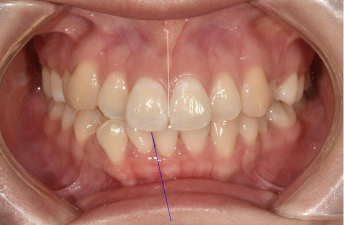 인비절라인 비발치 토끼이빨 교정 덧니 교정 치료기간 1년 8개월 관련 이미지 2