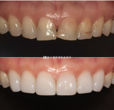 Laminate Veneers in Your 50s: Is It Possible Without Shaving Down the Teeth? | No-Prep Laminate Veneers + Real Case of Front Tooth Partial Orthodontics image 1