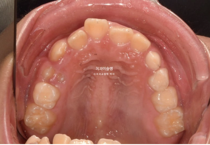 선천적 결손 잔존유치 과개교합 돌출입 인비절라인 퍼스트 어린이 투명교정 치료기간 관련 이미지 4