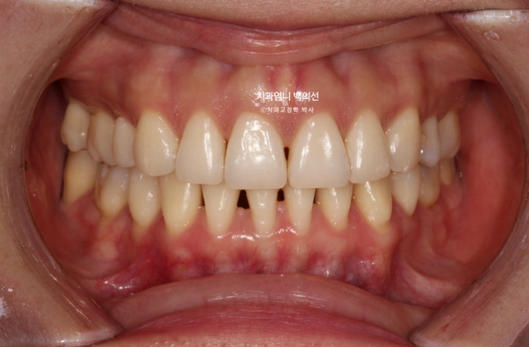 옥니 교정 역교정 재교정 무턱교정 치료기간 1년 10개월 관련 이미지 2