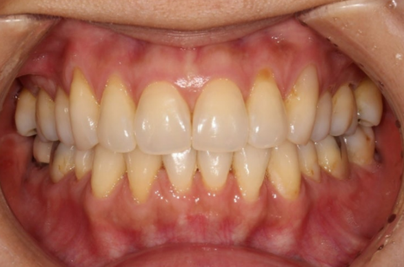 블랙트라이앵글 없애는 교정 가능할까요? 재교정 단기교정 후기 관련 이미지 6