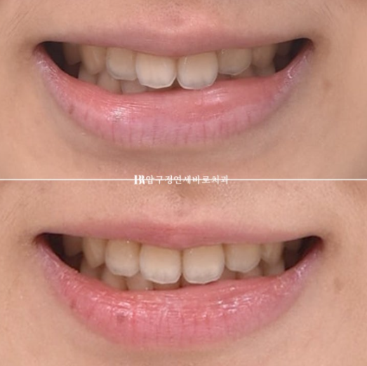 인비절라인 익스프레스 토끼이빨 교정 기간? 인비절라인 종류는? 관련 이미지 16