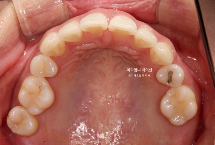 옥니 교정 역교정 재교정 무턱교정 치료기간 1년 10개월 관련 이미지 4
