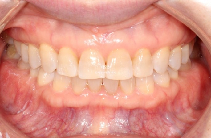 50대 치아교정 :: 인비절라인 익스프레스 치아 벌어짐 단기교정 후기 관련 이미지 13