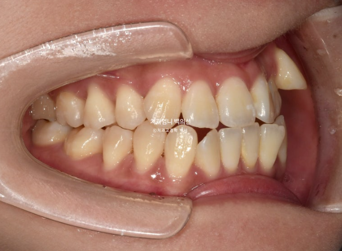 비발치 교정 덧니 인비절라인 교정 절단교합 반대교합 치료기간 1년 6개월 관련 이미지 6