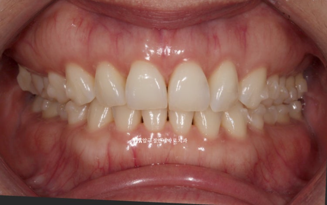 인비절라인 라이트 가위교합 벌어짐 중심선 미니스크류 치료기간 11개월 관련 이미지 6
