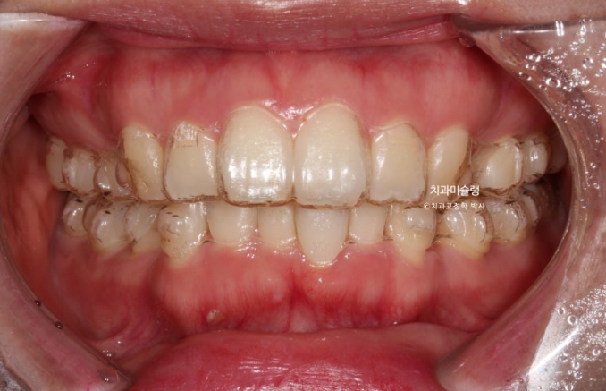 돌출입 덧니 발치 교정 인비절라인 교정 후기 관련 이미지 8