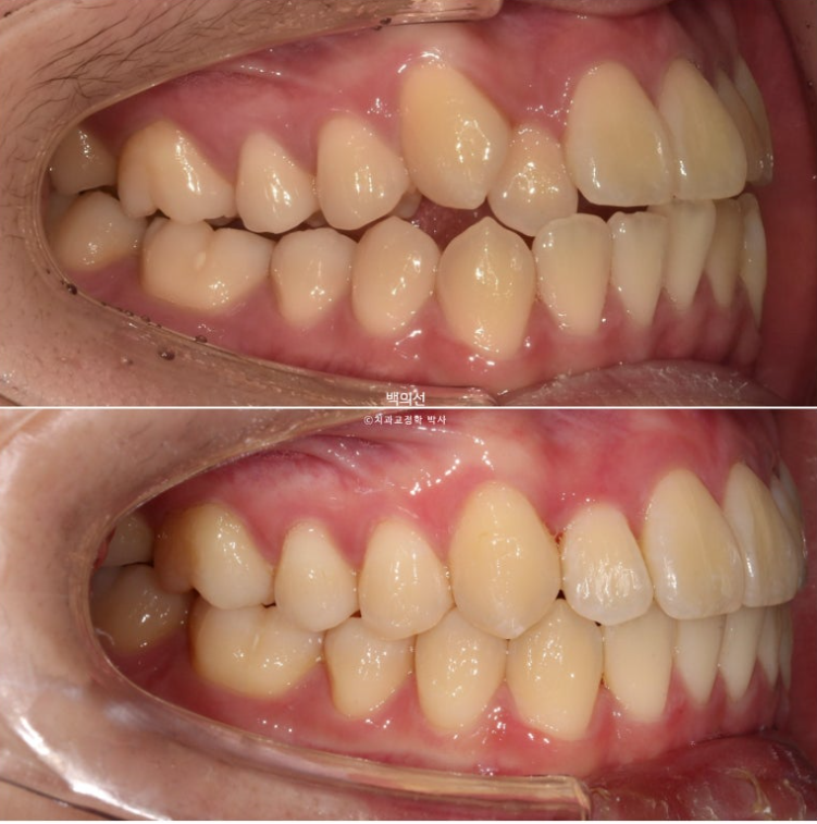 유학생 교정 덧니 반대교합 인비절라인 라이트 치료기간 관련 이미지 16