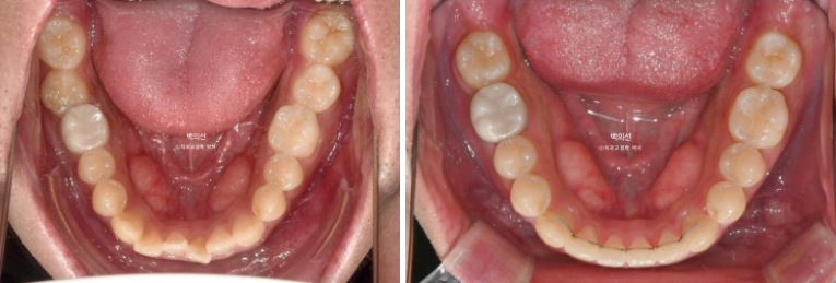 가위교합 나비치아 미니스크류 덧니 교정 인비절라인 라이트 관련 이미지 19