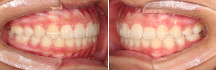 덧니 반대교합 과개교합 인비절라인 퍼스트 악궁확장 어린이 교정 관련 이미지 17