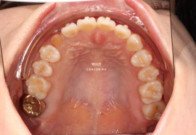 매복 결손 잔존유치 라미네이트 크라운 캔팅 인비절라인 라이트 치료 관련 이미지 15