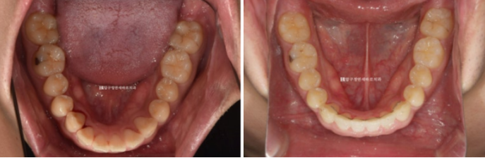 Can Invisalign Fix a Gap Between the Front Teeth? ๐ฎ A Real 9-Month Case Finished Without Remaking Aligners image 9