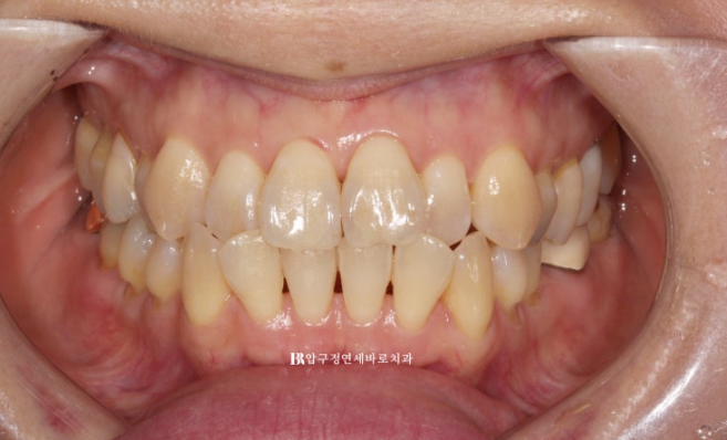 Orthodontics in Your 40s: Worried Your Gums Will Recede? | A 6-Month Front Teeth Partial Orthodontic Case That Also Improved Black Triangles image 2