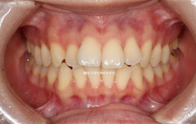 Orthodontic Treatment for International Students: Is Short-Term Treatment Possible in Korea? | A Real 5-Month Front Teeth Partial Orthodontic Case image 2