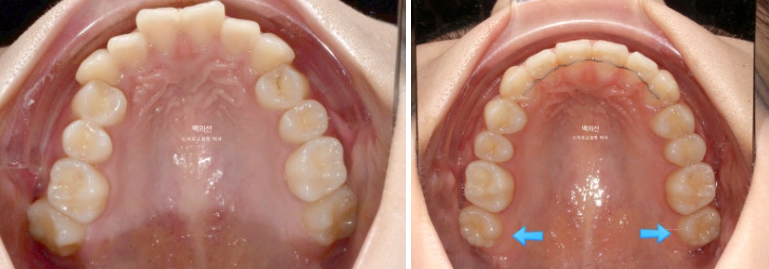 비발치 덧니교정 인비절라인 교정 사랑니 이용 교정 관련 이미지 15