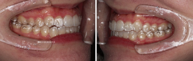 인비절라인 라이트 과개교합 반대교합 돌출입 뻐드렁니 교정 치료 관련 이미지 6