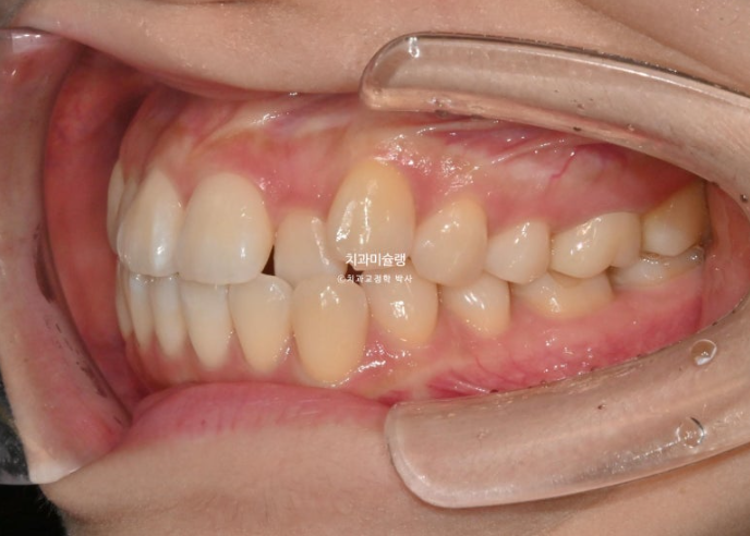 인비절라인 라이트 반대교합? 덧니 중심선 치간삭제 치료 관련 이미지 4