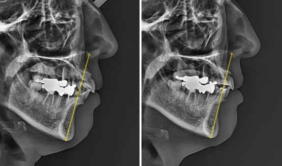 Orthodontic Retreatment in Your 40s | Improvement of Chin Retrusion and Lip Incompetence with Intrusion Orthodontics, Non-Extraction Orthodontic Treatment in Your 40s image 7