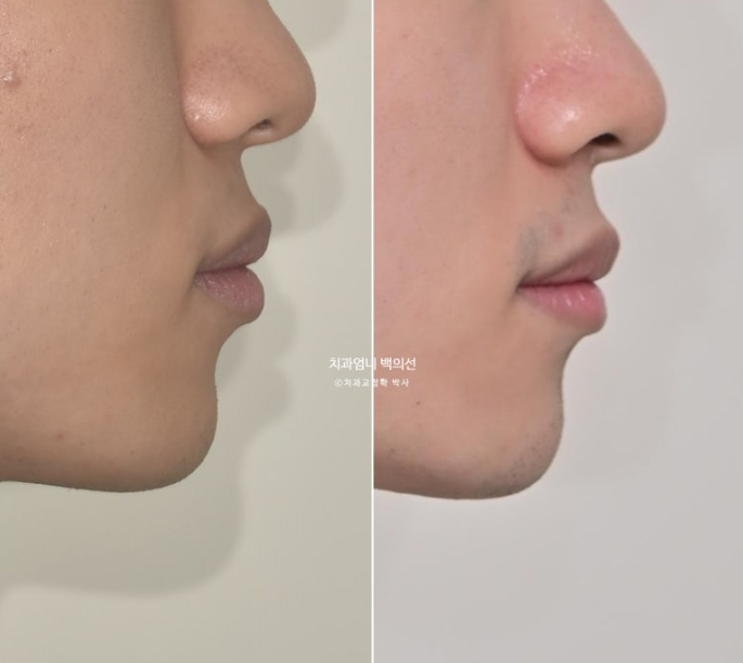 인비절라인 비발치 앞니 돌출 교정 치료기간 2년 5개월 관련 이미지 19