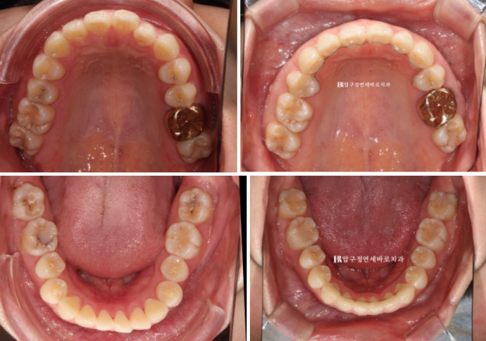 Gummy Smile Correction, Gummy Smile Orthodontics, Rabbit Teeth Correction image 10