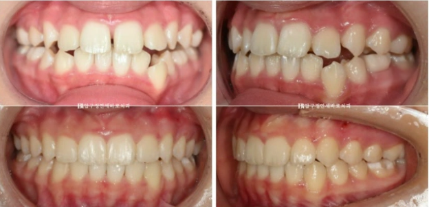 어린이 투명교정 인비절라인 틴 덧니 교정 후기 관련 이미지 16