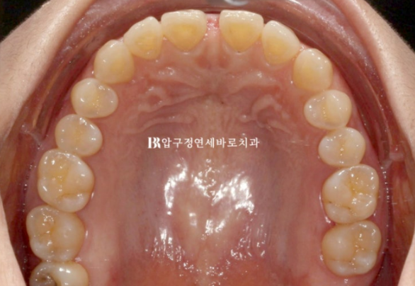 벌어진 앞니, 바로 라미네이트 하지 않은 이유｜인비절라인 후 무삭제 라미네이트 실제 사례 관련 이미지 5