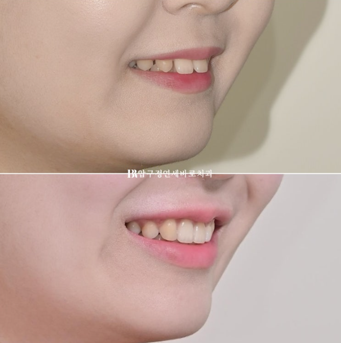 Actual Case of Treating Congenitally Missing and Peg-Shaped Teeth Without Implants image 18