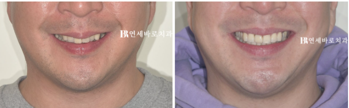 안보이는 앞니 교정 2D 교정 부분교정 후기 / 교정 시 잇몸이 더 나빠지지 않을까요? 관련 이미지 4