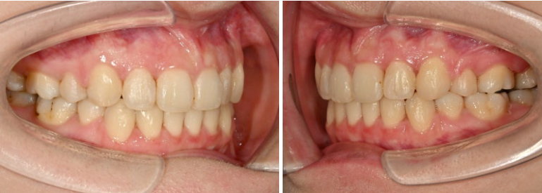 돌출입 인비절라인 발치교정 거미스마일 잇몸미소 잇몸돌출 입술부전증 무턱 재교정 관련 이미지 15