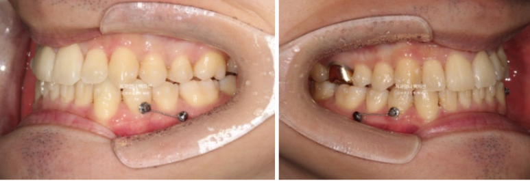 인비절라인 비발치 앞니 돌출 교정 치료기간 2년 5개월 관련 이미지 8